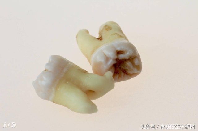 拔了智齿应该注意什么?智齿拔牙后注意事项-1